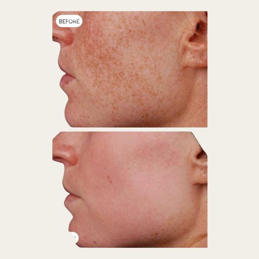 The Photo Facial